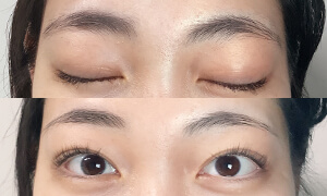 ブランクリニックで変わります！ メイク不要な眉に